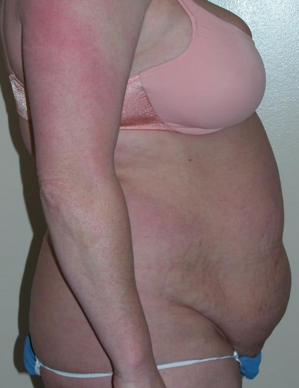 Before and after result from Utah Aesthetic Surgery.
