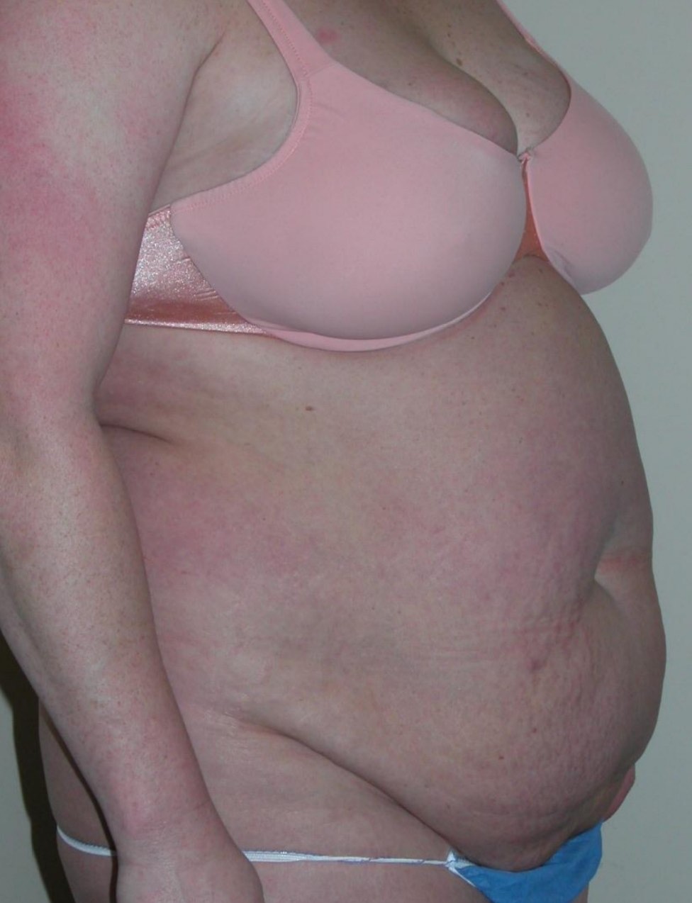 Before and after result from Utah Aesthetic Surgery.