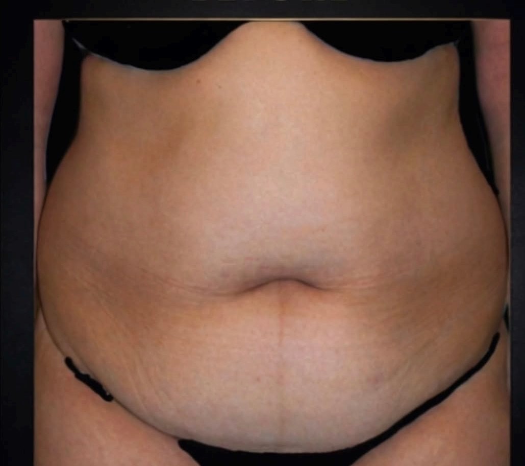 Before and after result from Utah Aesthetic Surgery.