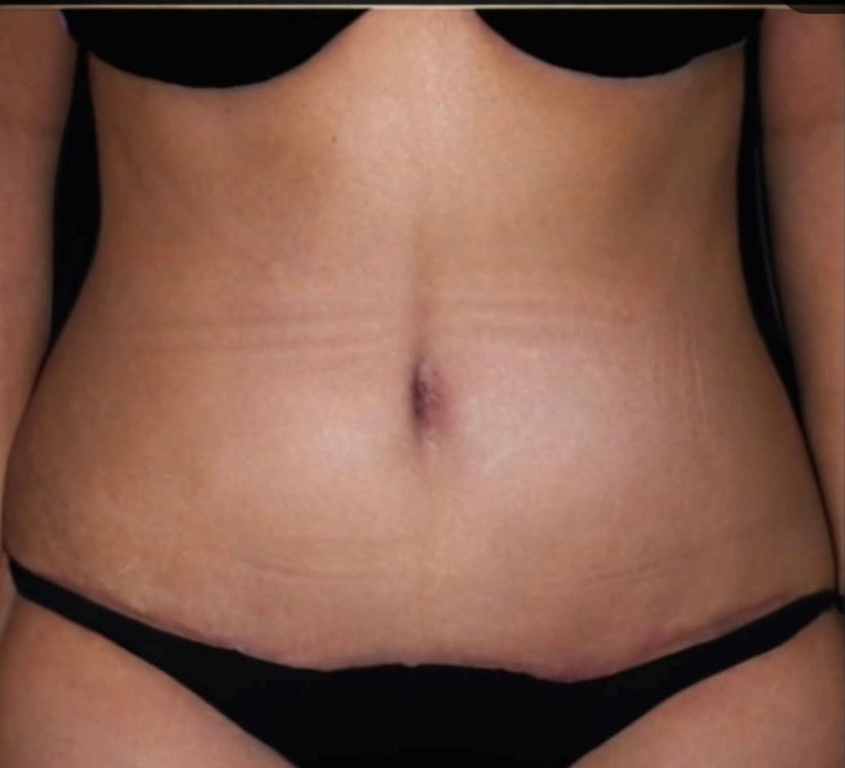 Before and after result from Utah Aesthetic Surgery.