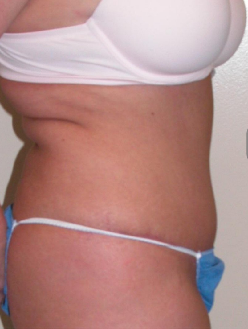 Before and after result from Utah Aesthetic Surgery.